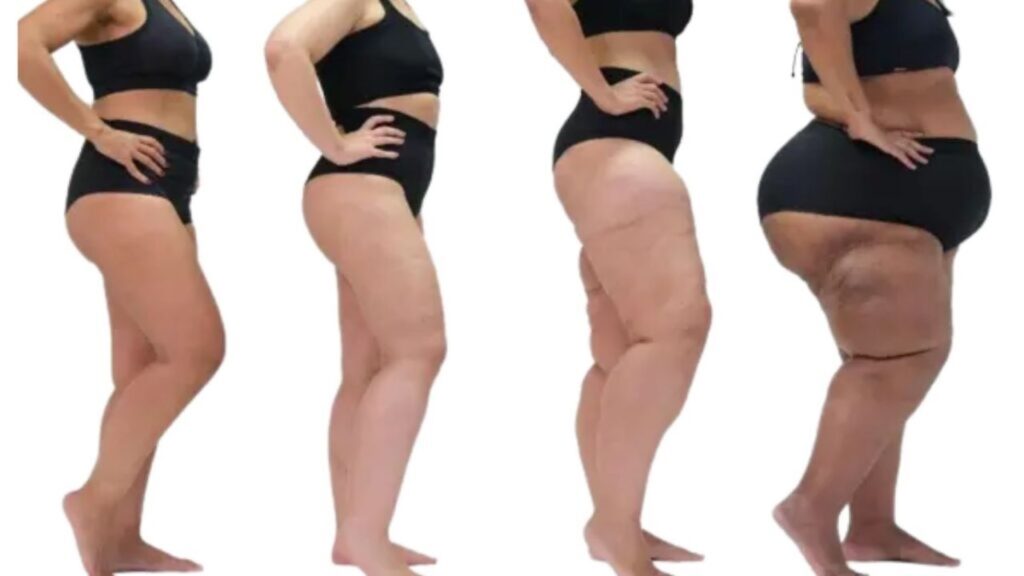9 Home Tips for Lipedema: Natural Ways to Manage Symptoms